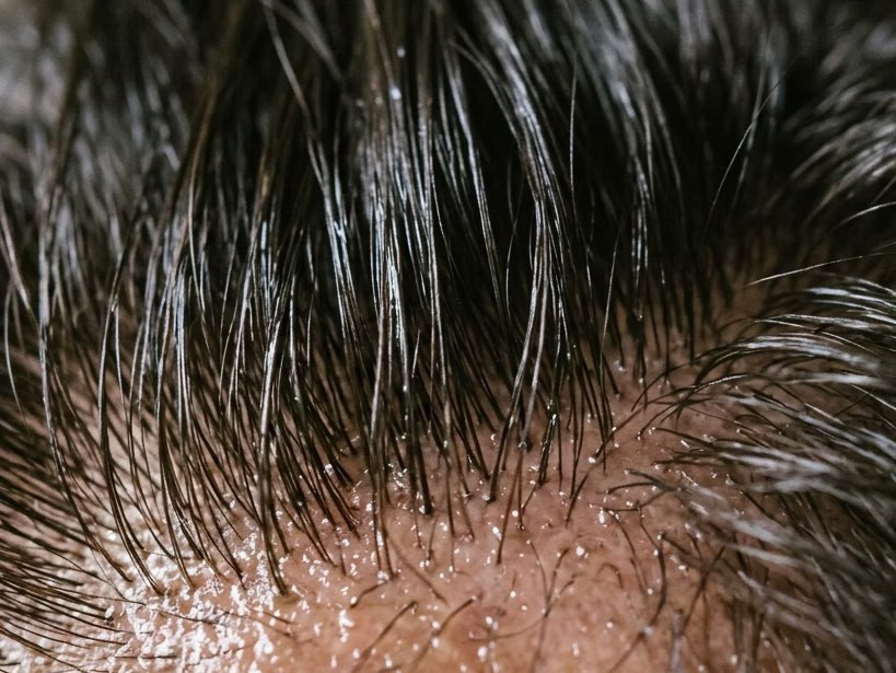 Why Your Hair Gets Greasy So Fast (And What It Means)